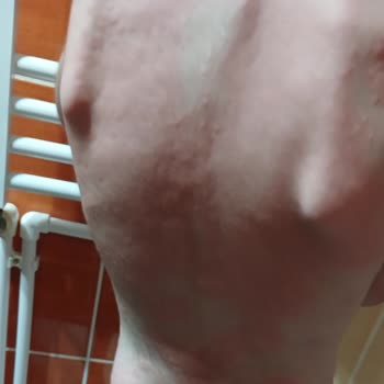 Duru Sabun Duru Marka Alerji Yaptı Cilt Döküntüsü Yaptı