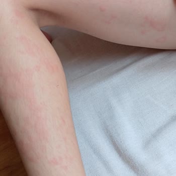 Duru Sabun Duru Marka Alerji Yaptı Cilt Döküntüsü Yaptı