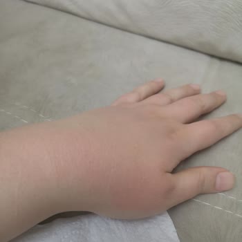 My Severe Allergic Reaction to Bepanthol Sensiderm Cream - No Help from Customer Service