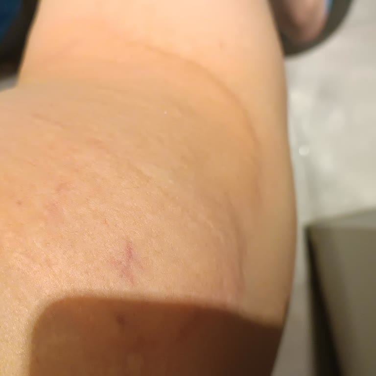 Şırnak Devlet Hastanesi Doktorun Umursamazlığı Ve Yanlış Tedavi