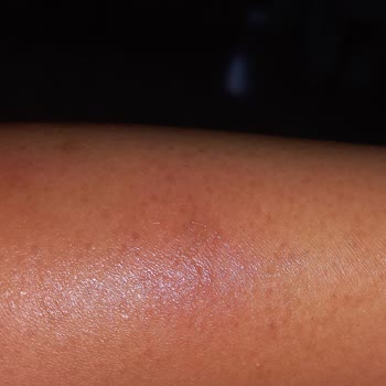 Hnk Teknoloji Tarafından Satılan Riomi Buz Lazer Aleti Cildimi Yaktı