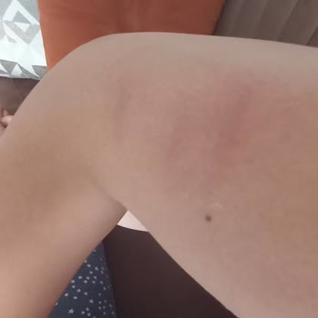 Hnk Teknoloji Tarafından Satılan Riomi Buz Lazer Aleti Cildimi Yaktı