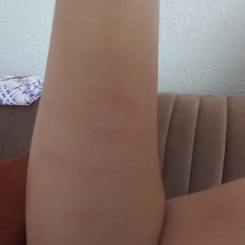 Hnk Teknoloji Tarafından Satılan Riomi Buz Lazer Aleti Cildimi Yaktı