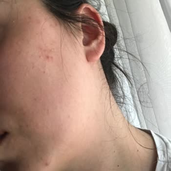 Bioderma Güneş Kremi Yoğun Sivilce Sorunu