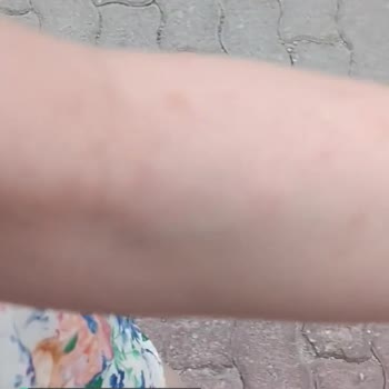 Sebamed Güneş Losyon Alerji Yaptı!