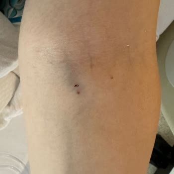 Memorial Hastanesi Memorial Şişli 7 Damar Yolu Deliği