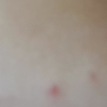 Bioderma Sivilce Ve Kızarıklık!