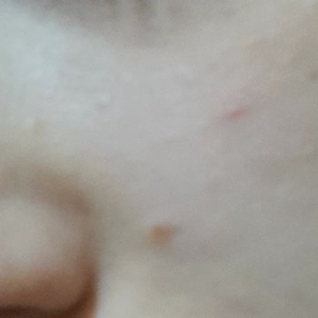 Bioderma Sivilce Ve Kızarıklık!