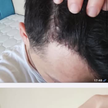 İstanbul Hairline Sac Ekim Memnuniyetsizliği