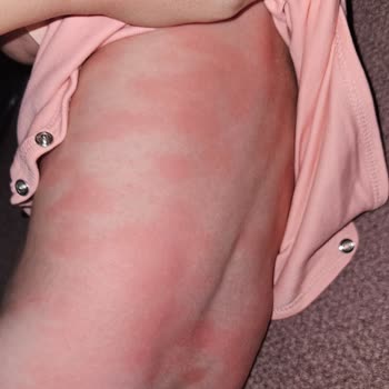 Mustela Ürünleri Bebeğimde Alerji Yaptı!