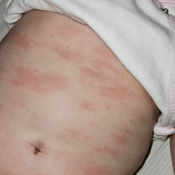 Mustela Ürünleri Bebeğimde Alerji Yaptı!