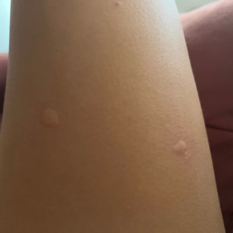 Antalya Büyükşehir Belediyesi Sivrisinek Sorunu!