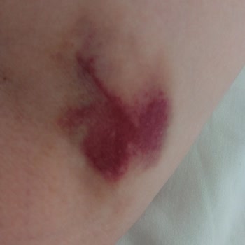 Vega Hospital Damar Yolu Bile Açamama