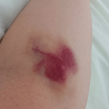 Vega Hospital Damar Yolu Bile Açamama