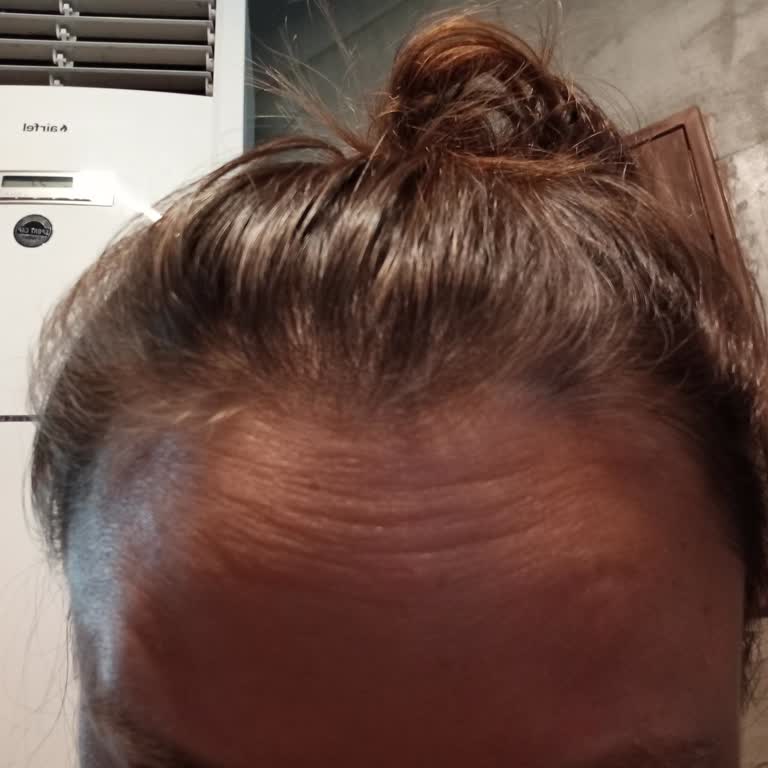 Estrella Medical Group Kötü Botoksa Müdahale Edilmemesi