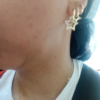 Yves Rocher'in Yüzümde Bıraktığı Sivilceler Ve İzler