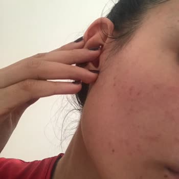 Hada Labo Tokyo Hada Labo Güneş Kremi Kullanımı Sonrası Cilt Sorunları