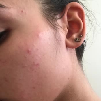 Hada Labo Tokyo Hada Labo Güneş Kremi Kullanımı Sonrası Cilt Sorunları