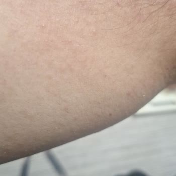 Orzax İlaç Vücut Da Kızarıklık