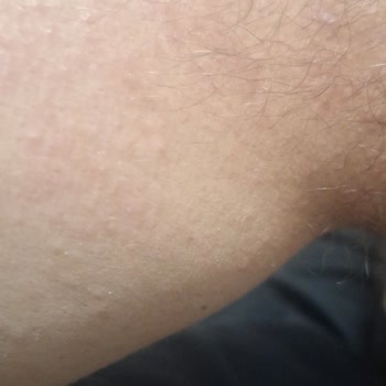 Orzax İlaç Vücut Da Kızarıklık