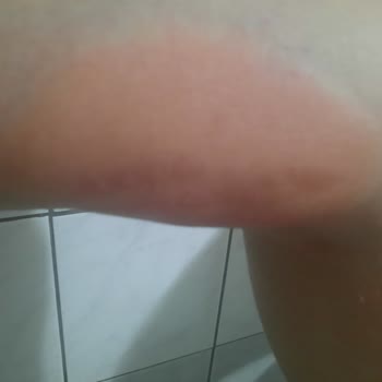 Herbalife Alerjik Reaksiyondan Dolayı Vücudumda Yaralar Oluştu