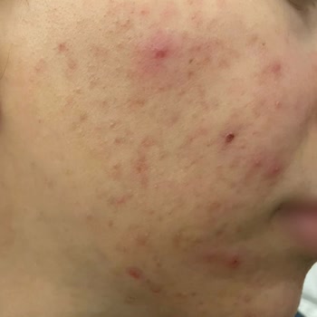 Samsun Çarşamba Lilium Güzellik Merkezi Cildimi Mahvetti Muhatap Yok