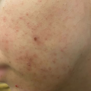 Samsun Çarşamba Lilium Güzellik Merkezi Cildimi Mahvetti Muhatap Yok