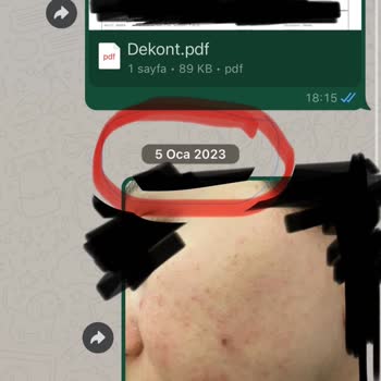 Samsun Çarşamba Lilium Güzellik Merkezi Cildimi Mahvetti Muhatap Yok