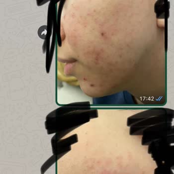 Samsun Çarşamba Lilium Güzellik Merkezi Cildimi Mahvetti Muhatap Yok