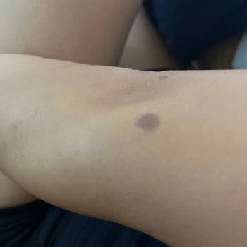 Enza Güzellik Merkezleri Lazer Yaparken Yaktılar