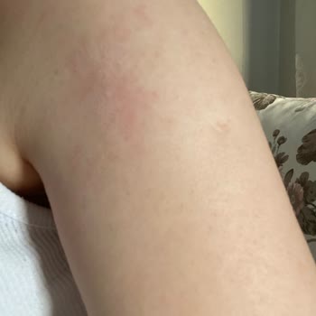 Agiva Renk Açıcı Sprey Vücudumda Reaksiyona Sebep Oldu