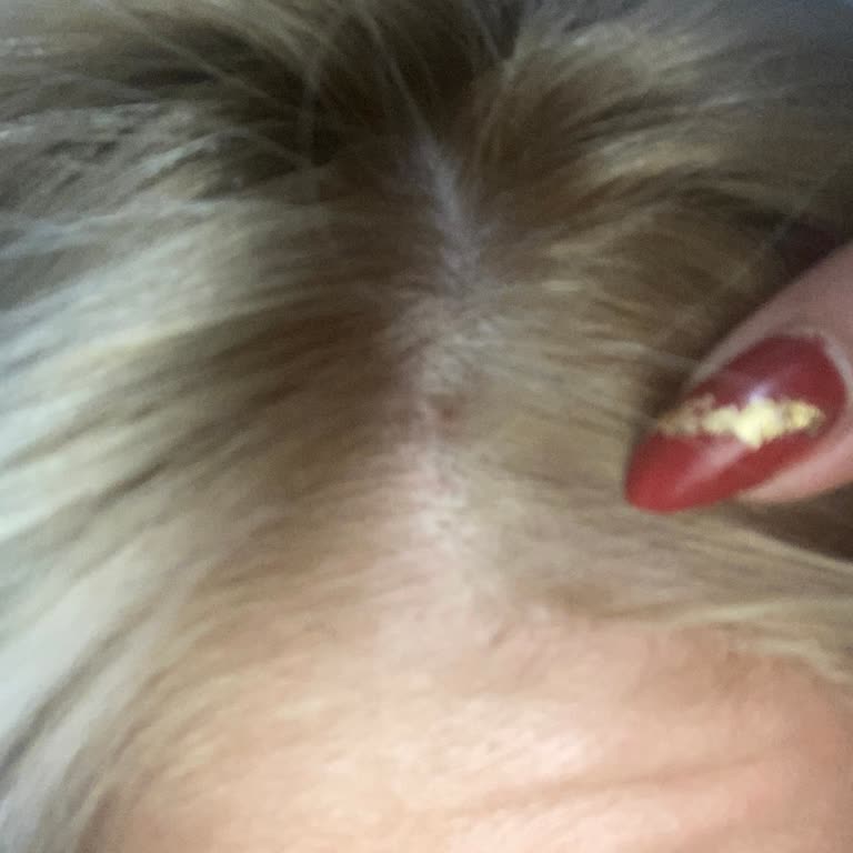 Palette Kafamda Yara Oluştu İlk Defa 10.1