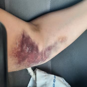 Medical Park Hastanesi Kan Alma Sürecinde Yaşanan Sorunlar Ve Sonuçları