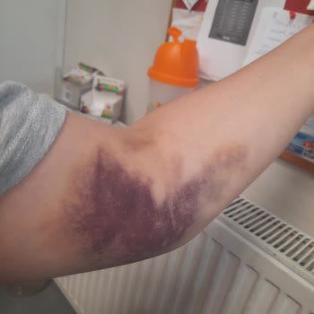 Medical Park Hastanesi Kan Alma Sürecinde Yaşanan Sorunlar Ve Sonuçları