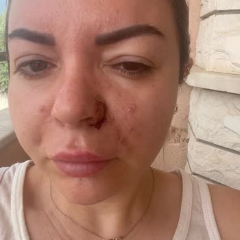 Medica World Estetik Yanlış Tıbbi İşlem Ve İlgisizlik Nedeniyle Mağduriyet