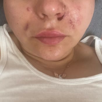 Medica World Estetik Yanlış Tıbbi İşlem Ve İlgisizlik Nedeniyle Mağduriyet