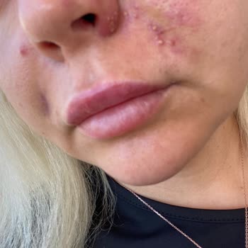 Medica World Estetik Yanlış Tıbbi İşlem Ve İlgisizlik Nedeniyle Mağduriyet