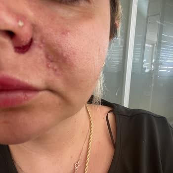 Medica World Estetik Yanlış Tıbbi İşlem Ve İlgisizlik Nedeniyle Mağduriyet