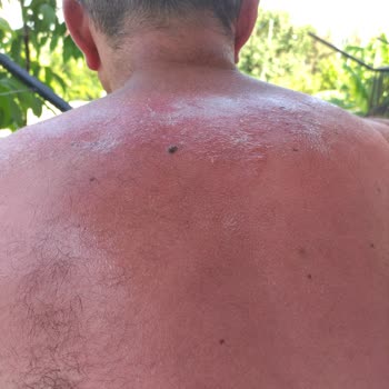Nivea Güneş Koruyucu Krem Korumadı