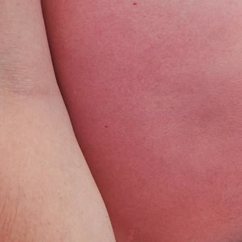 Mustela Güneş Kremi Güneş Yanığına Sebep Oldu!