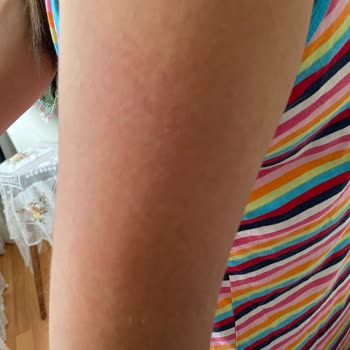 Bioxcin Sun Care 50+ Çocuk Losyonu Kızımın Cildini Mahvetti