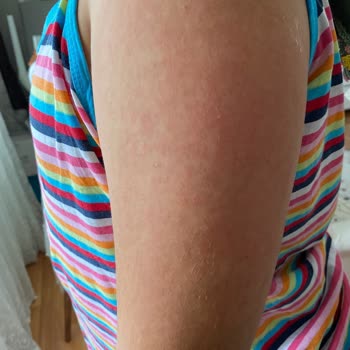 Bioxcin Sun Care 50+ Çocuk Losyonu Kızımın Cildini Mahvetti