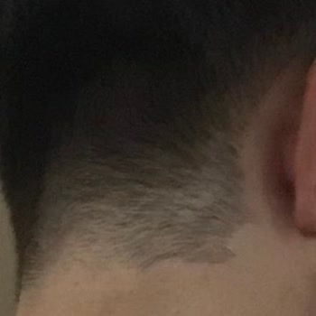 Lifemed Tıp Merkezi Ense Lazeri Operasyondaki Personel Ense Çizgim Mahvetti