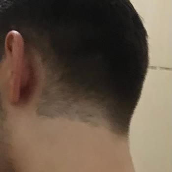 Lifemed Tıp Merkezi Ense Lazeri Operasyondaki Personel Ense Çizgim Mahvetti