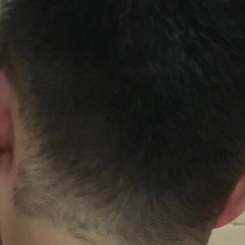 Lifemed Tıp Merkezi Ense Lazeri Operasyondaki Personel Ense Çizgim Mahvetti