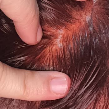 Palette Marka Saç Boyası Kafa Derimi Yaktı