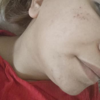 Sesu Yüzüme Bir Çözüm Bulun 🙁