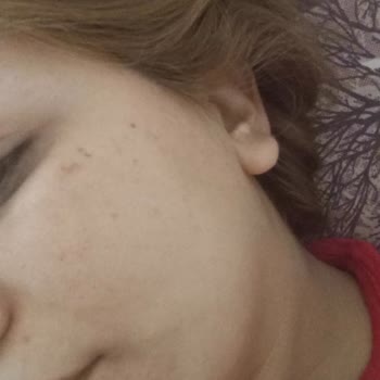 Sesu Yüzüme Bir Çözüm Bulun 🙁