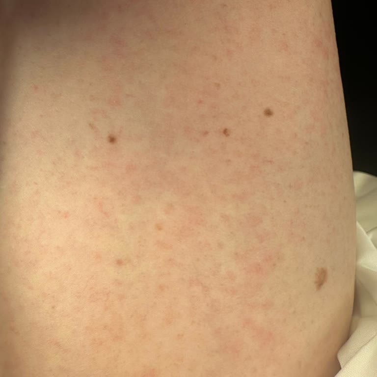 Yves Rocher Cilt Tahrişi Yaratan Peeling Ürünü