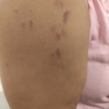 Şennur Akpınar Güzellik Salonu Bursa Lazer Yanığı